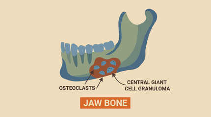 Central Giant Cell Granuloma Jaw Osteoclastic © Bima