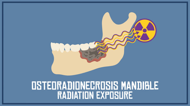 Osteoradionecrosis Mandible Bone Exposure Radiation