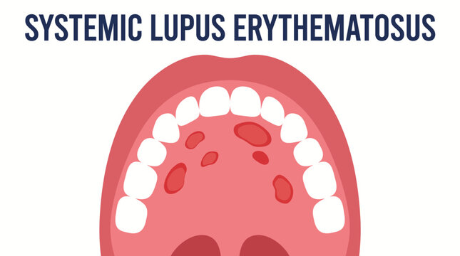 Systemic Lupus Erythematosus Oral Ulceration Palatal