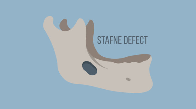 Stafne Defect Static Bone Cavity Mandible
