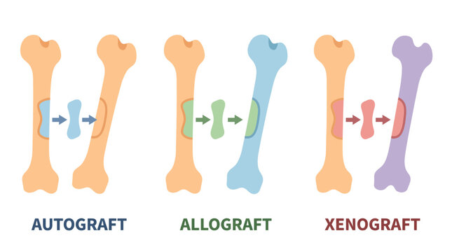 Bone Graft Types Autograft Allograft Xenograft