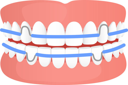 Flat vector dental braces on teeth smile illustration of mouth with orthodontic appliance and gums