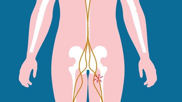 A sciatic pinched nerve shooting pain radiating from the lower back through the leg medical anatomy illustration