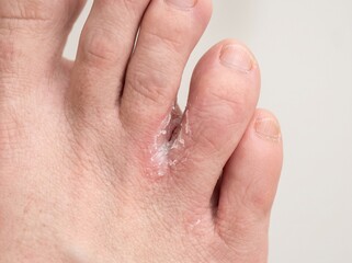 Fototapeta premium Athlete’s Foot Tinea Pedis Fungal Infection Between Toes Close Up Dermatology