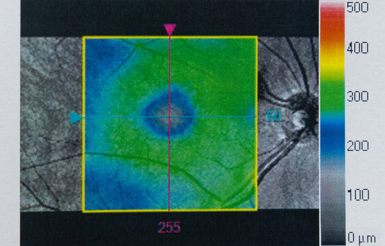 An Optical Coherence Tomography (OCT) scan of the human retina, specifically capturing the macular degeneration