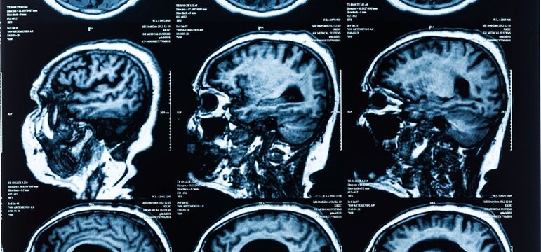Medical scan shows human brain in cross-sections. Imagery reveals detailed structure of cerebral tissue. Images display sagittal, axial, and coronal views