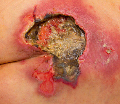 Pressure ulcer in the sacral (coccyx) region with necrotic tissue, slough and granulation tissue. Close-up of a chronic wound during medical treatment and wound care.