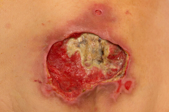 Stage IV pressure ulcer in the sacral (coccyx) region with necrotic tissue, slough and granulation tissue. Close-up of a chronic wound during medical treatment and wound care.