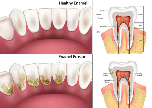 Medical vector illustration comparing healthy teeth with enamel erosion. Detailed cross section anatomy highlights enamel, dentin, pulp cavity, root canal, and exposed dentin caused by acid wear