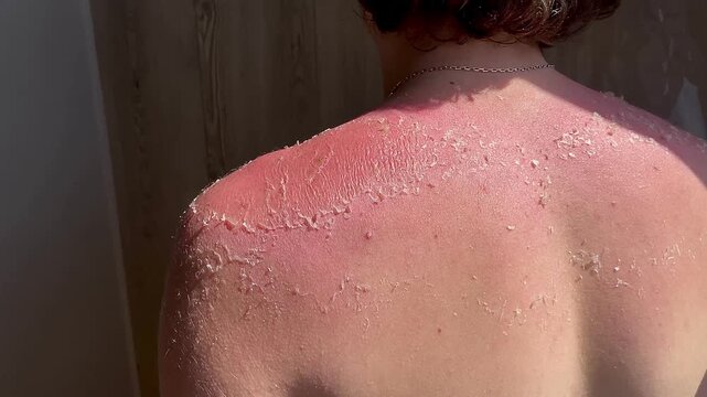 Burnt red skin. The skin flakes off a lot after the sun. The tanned back and shoulders of a young guy. The concept of tanning. 4k