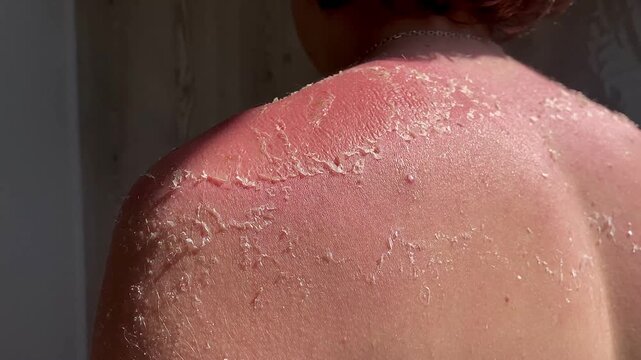Burnt red skin. The skin flakes off a lot after the sun. The tanned back and shoulders of a young guy. The concept of tanning. 4k