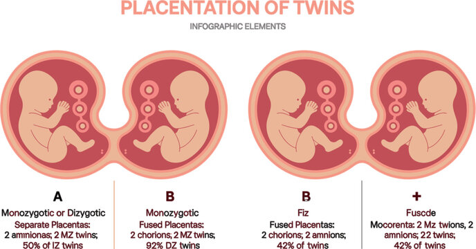 Placentation of Twins Medical Infographic Vector Set Showing Monozygotic and Dizygotic Fetal Development, Separate Placentas, and Fused Amniotic Sac Diagrams for Healthcare Education