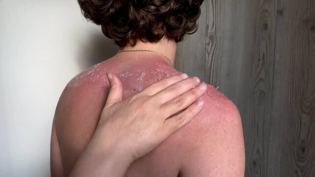 A woman smears cream on a young guy's shoulders. Burnt red skin. The skin flakes off a lot after the sun. The tanned back and shoulders of a young guy. The concept of tanning. 4k