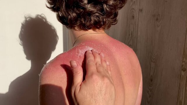 A woman smears cream on a young guy's shoulders. Burnt red skin. The skin flakes off a lot after the sun. The tanned back and shoulders of a young guy. The concept of tanning. 4k