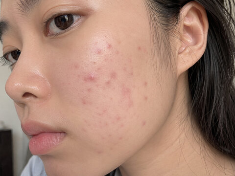 Teenage Acne Struggle: A close-up shot focuses on a young woman's face, highlighting her struggle with acne and the emotional toll it takes, urging for self-acceptance and skincare awareness.