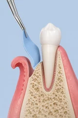 Dental elevator reflecting gum flap beside tooth root and jaw bone © Nadia