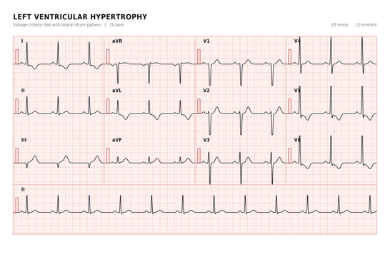 Left Ventricular Hypertrophy 12-Lead ECG with Voltage Criteria and Strain Pattern