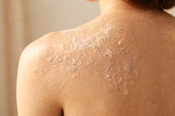 Fototapeta premium Close Up of Dry Flaky Skin on Woman Back
