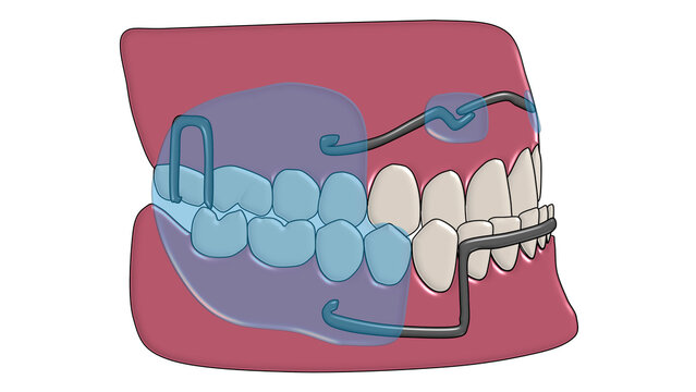 3D Illustration of Fr&auml;nkel Function Regulator 3 (FR-3) Orthodontic Appliance