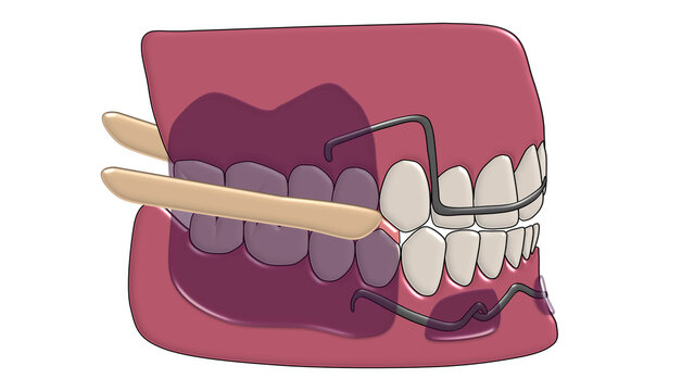 3D Illustration of Fr&auml;nkel Function Regulator 5 (FR-5) Orthodontic Appliance