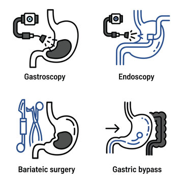 Vector art of set of four medical icons illustrating gastroscopy, endoscopy, bariatric surgery, and gastric bypass procedures on a