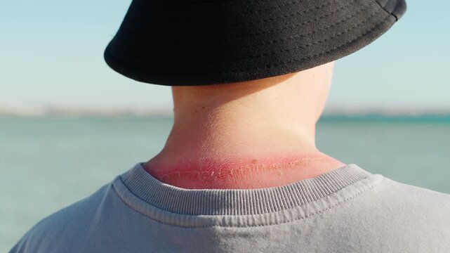 Painful sunburn on the back and neck of a teenage child. Close-up of reddened and flaky skin.