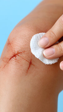Knee scrape wound care with cotton pad on skin in bright daylight, closeup of hand cleaning injury with soft blue background