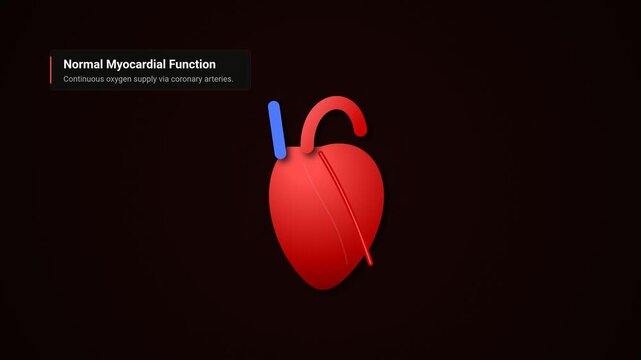 3D animation detailing the mechanism of myocardial infarction, illustrating atherosclerosis, plaque rupture, thrombosis, total occlusion, and subsequent myocardial ischemia leading to a heart attack