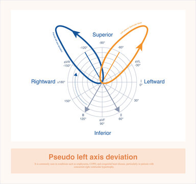 In cases of extreme right axis deviation, the electrical axis in the frontal plane lies in the upper-right quadrant or even rotates counter clockwise into the upper-left quadrant, resulting in pseudo 