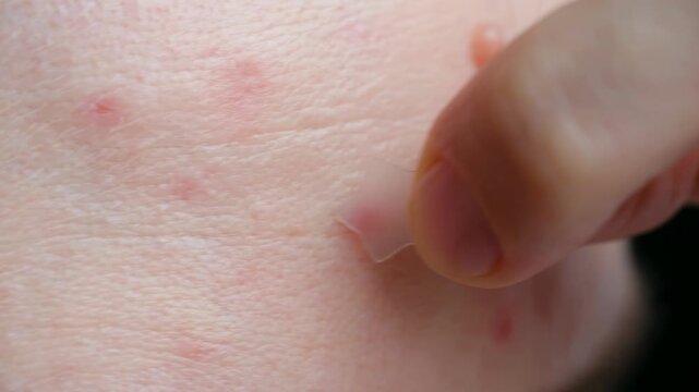 Close up woman with problem skin applying star shaped hydrocolloid patch to treat pimple skincare routine for blemish acne prone skin with red spots on cheek. Person applying hydrocolloid pimple patch