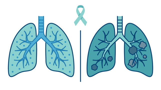 Comparative medical illustration showing healthy lungs versus diseased lungs with lung cancer awareness ribbon