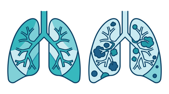 Healthy and diseased lung vector icon comparison showing respiratory damage