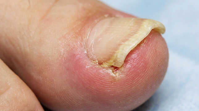 Close-up of inflamed ingrown toenail on big toe inflammation