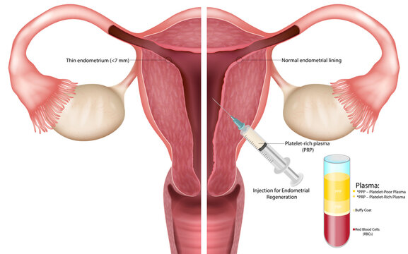 Medical  illustration showing thin endometrium before and after platelet-rich plasma (PRP) therapy. Cross-sectional uterus anatomy demonstrating PRP injection 
