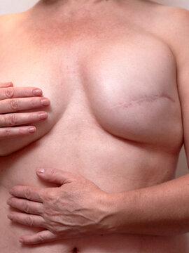 Vertical close-up of a woman's breast cancer mastectomy scar