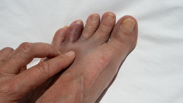 A close-up of a woman's hand touching a swollen area on her foot after hitting a rock. Concepts of foot injury, pain, trauma, medical care, and recovery.