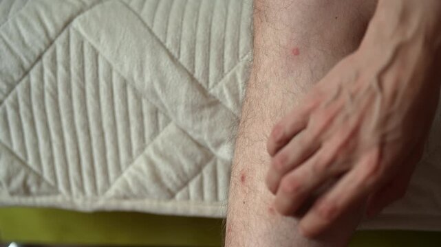 Male person scratching leg suffering from allergic reaction to insect bites. Concept of red rash and irritated skin after being bitten by mosquitoes sleeping in bed at night, close-up, slow motion.
