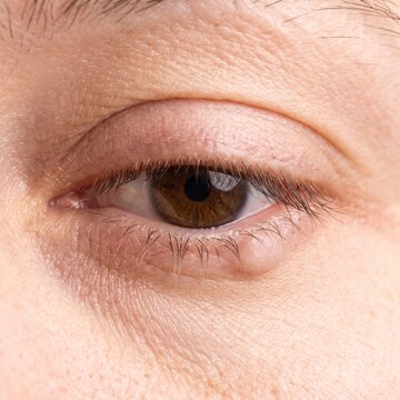 Close-up of eye with chalazion bump on eyelid  