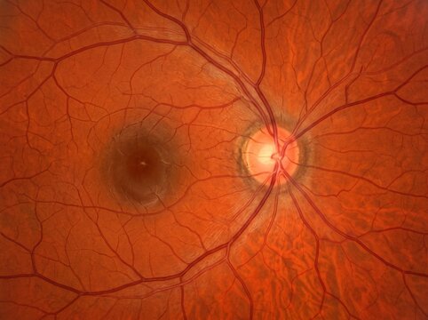 Fundus image showing optic disc and retinal blood vessels  