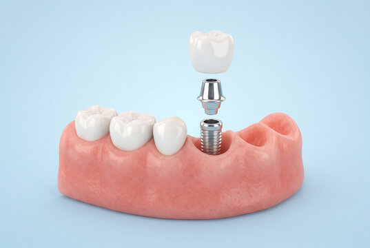 Dental Implant Model with Gum Tissue and Ceramic Crown for Oral Restoration Education
