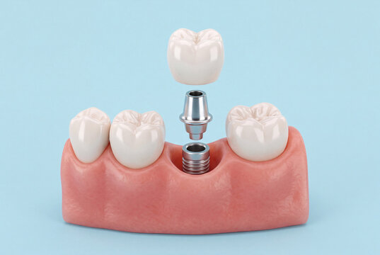 Dental Implant Model with Artificial Gum Tissue and Ceramic Crown for Educational Medical Illustration