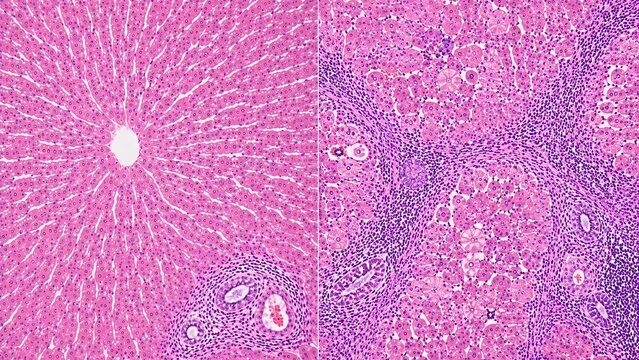 Healthy Liver vs Chronic Hepatitis Histopathology H&E Microscopy Comparison Ultra Realistic