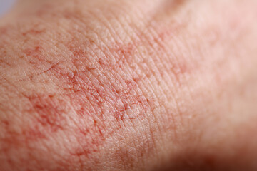 Fototapeta premium skin dermatitis rash