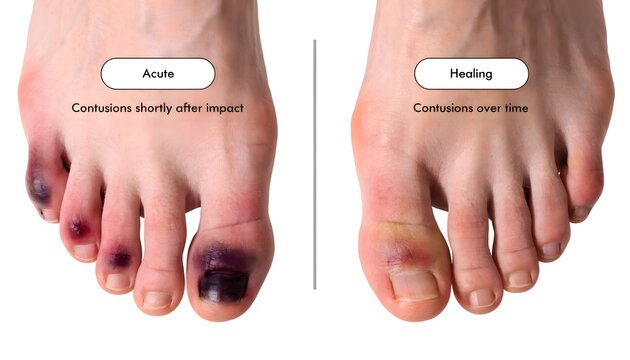 Multiple toe contusions from impact showing comparison healing stages, frontal view on white background