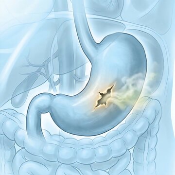 Stomach Perforation, Gastric Perforation, : a stomach with a visible tear or perforation in its wall, allowing subtle leakage of gastric contents into the surrounding abdominal cavity. 