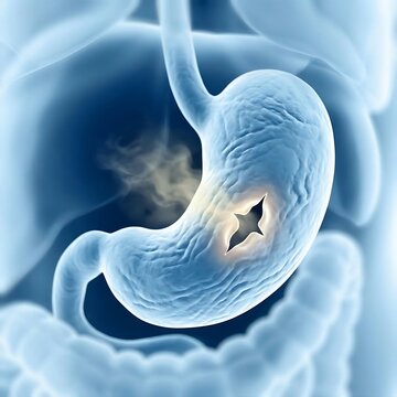 Stomach Perforation, Gastric Perforation, : a stomach with a visible tear or perforation in its wall, allowing subtle leakage of gastric contents into the surrounding abdominal cavity. 
