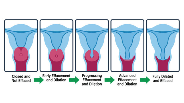 Cervical effacement and dilation stages vector, medical diagram of labor progression, anatomical stages of childbirth and uterine changes