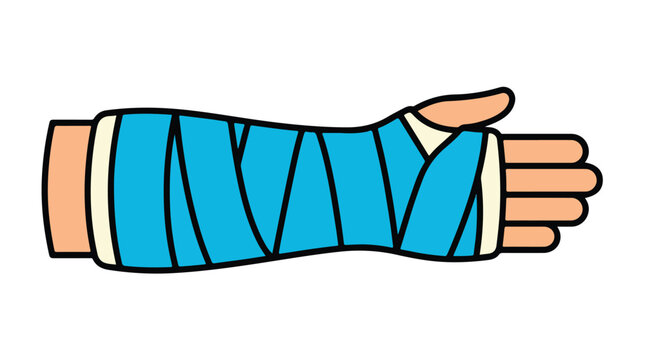 Broken arm in blue medical cast vector illustration, injured human hand with orthopedic bandage, healthcare and bone fracture recovery concept