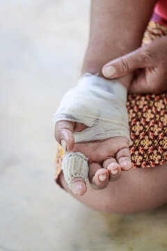 Hand of woman injured and bandaged