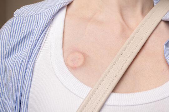 detailed close-up of an implanted chest port partly covered by a crossbody bag strap, illustrating everyday friction, sensitive skin and oncology lifestyle adaptation